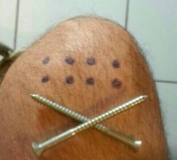 Imagem engraçada 2 Parafusos e 8 Pontos no Joelho no iPiadas